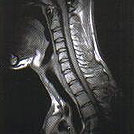 頚椎T2強調像の画像