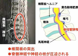 脊柱管狭窄症image