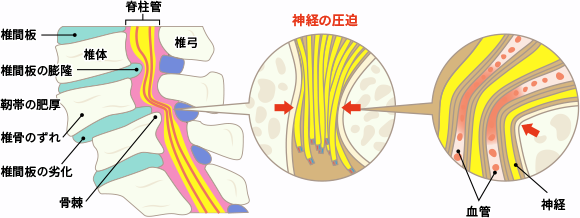 狭窄した脊柱管の拡大図image