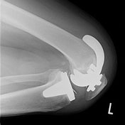 人工膝関節置換術image