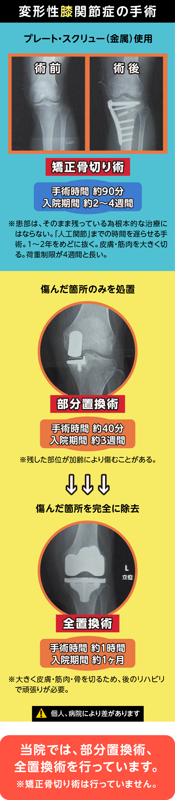 変形性膝関節症の手術