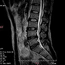 腰椎T2強調像の画像