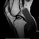膝関節T1強調像の画像
