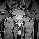 股関節T2強調像の画像