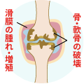 慢性関節リウマチ 概念図