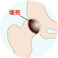 骨壊死症 概念図