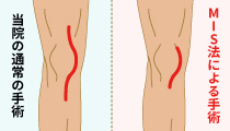 MIS（最小侵襲手術）法 概念図