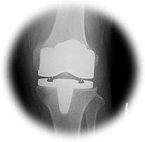 人工ひざ関節置換術写真
